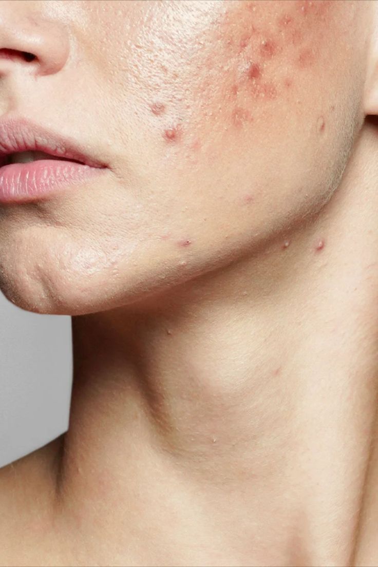 Acne Treatment image